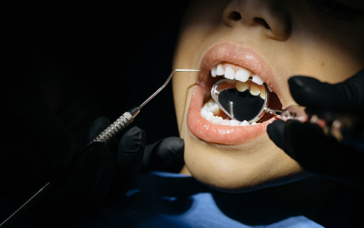 What price and reimbursement for dental veneers?